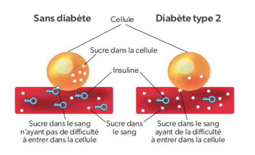 le diabete