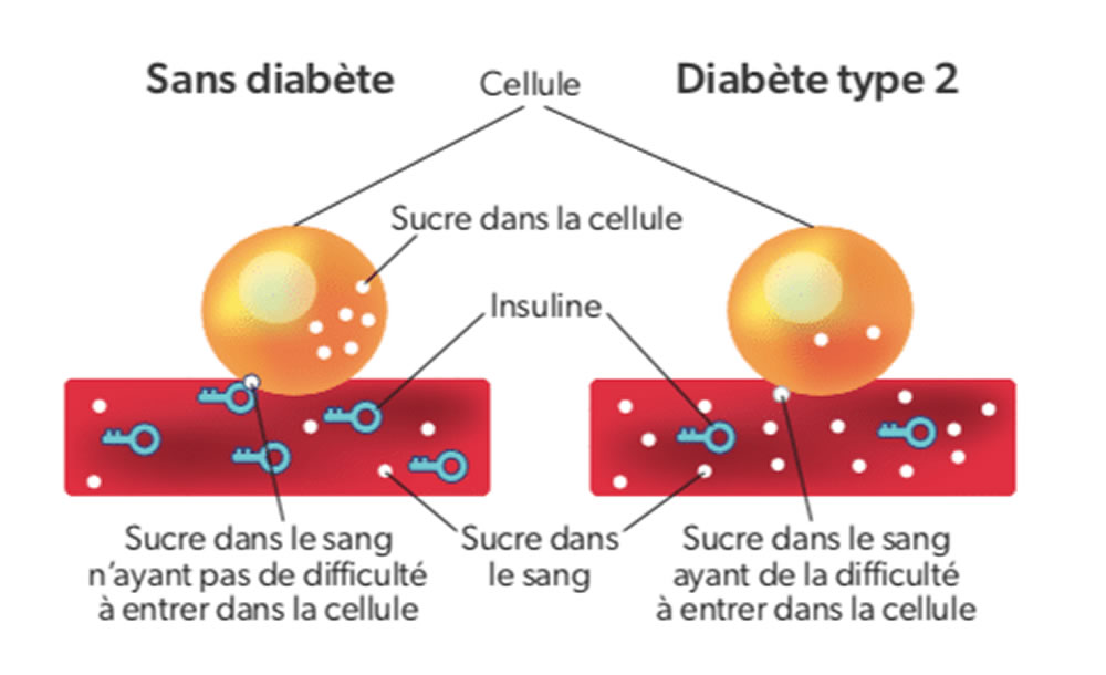 Les différents types de diabète - CLINIQUE ACODESS